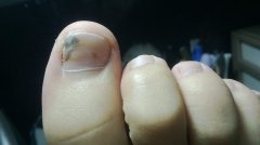 怎樣治療灰指甲？